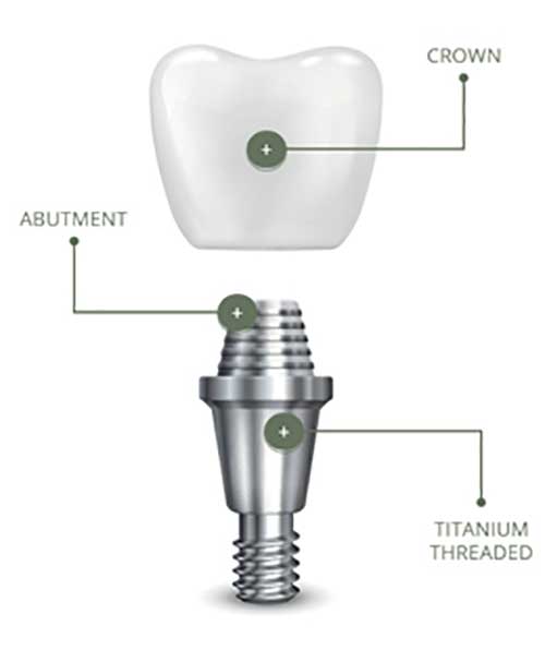Dental Implant Solutions in McAllen