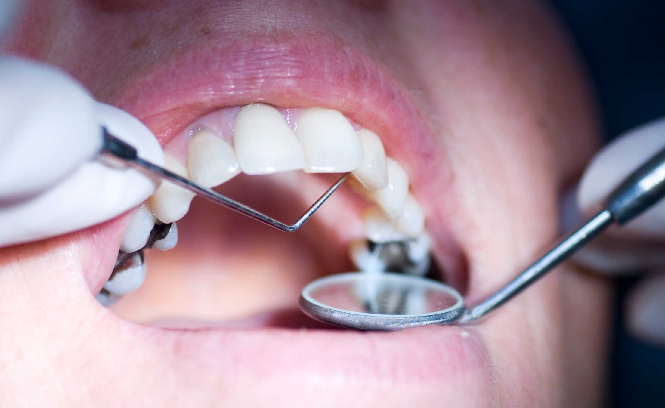 Silver amalgam fillings visible on molar teeth during a dental examination in McAllen, TX